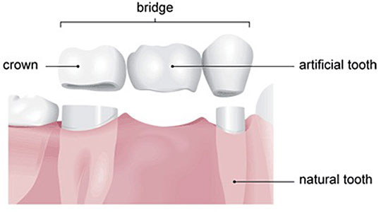 Dental Crowns and Bridges