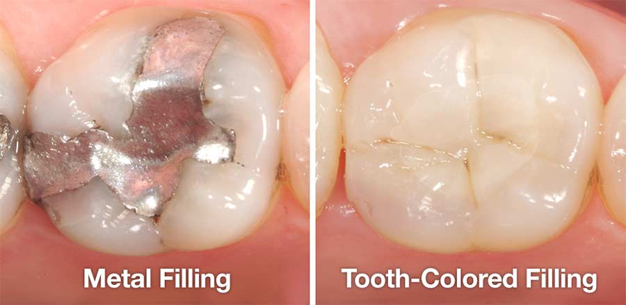 Tooth Fillings