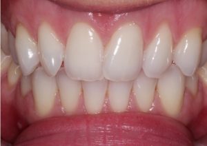 Teeth Bleaching /Whitening  -(After)