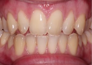 Teeth Bleaching /Whitening  -(Before)