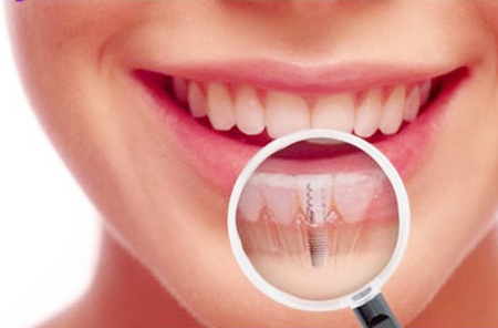 Dental Implants