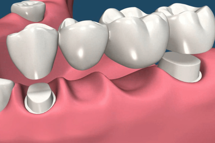 Dental Crowns and Bridges