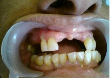 Smile Rehabilitation - Replacement of multiple missing teeth -(Before)