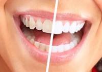 Teeth discolorations can be extrinsic or intrinsic.