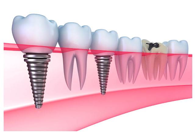 Dental implants are natural-looking replacements for missing teeth.They provide the same function as the natural tooth roots.