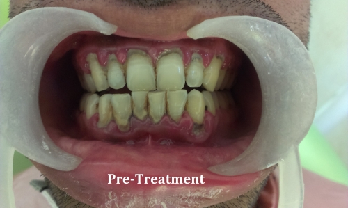 Generalised Periodontitis  -(Before)