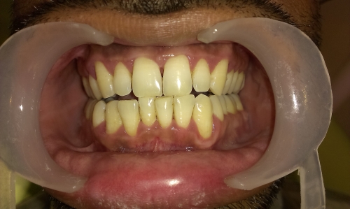 Generalised Periodontitis  -(After)