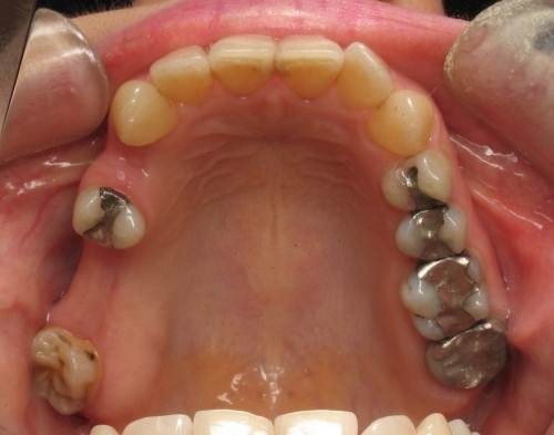 Implant Supported Bridge To Replace Multiple Missing Teeth  -(Before)