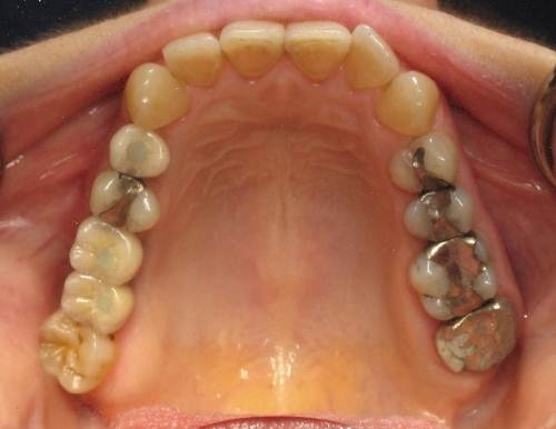 Implant Supported Bridge To Replace Multiple Missing Teeth  -(After)