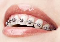 Orthodontics is that branch of dentistry which specializes in the diagnosis, prevention and treatment of problems in the alignment of teeth and jaws