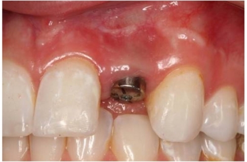  Single Tooth Replacement with Dental Implant  -(Before)