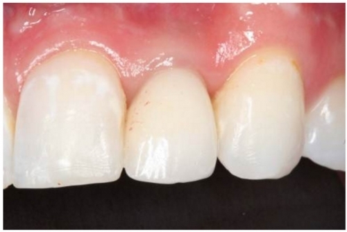  Single Tooth Replacement with Dental Implant  -(After)