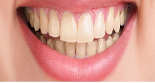 Teeth Bleaching Procedure -(Before)