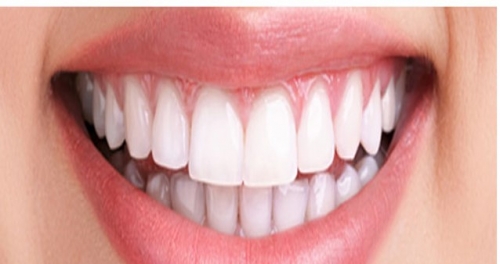 Teeth Bleaching Procedure -(After)